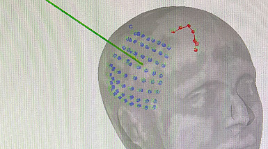 Imagen del cráneo de una persona con puntos azules y rojos en una zona del cerebro y una línea verde.