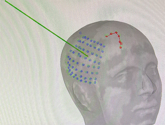 Imagen del cráneo de una persona con puntos azules y rojos en una zona del cerebro y una línea verde.